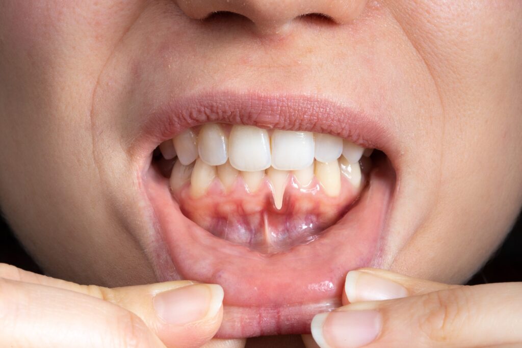 Preparing for teeth whitening with receding gums Brackley